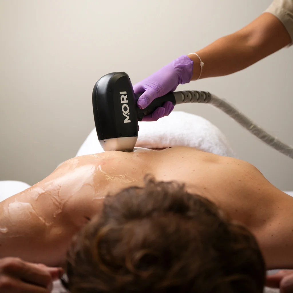 12x Bovenlichaam laser ontharen (man)
